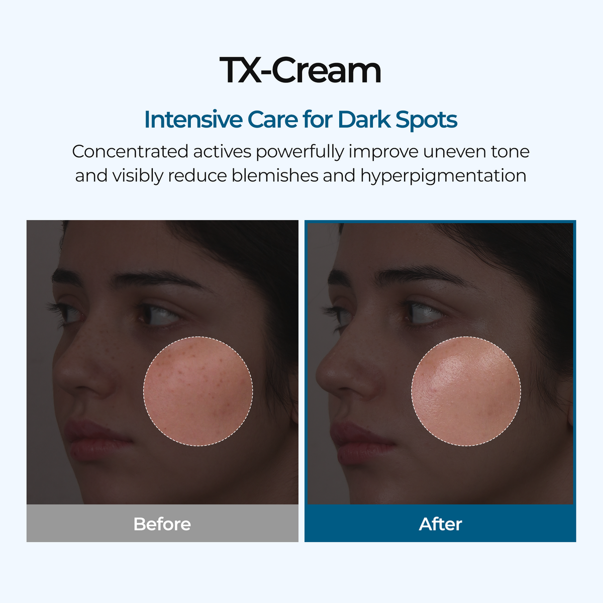 DR.Melaxin TXA Tranexamic Acid CREAM | Skin freckle Cream, Blemishes, Anti-pigmetation korean skin care | Korean Cosmetics | 1.7 fl oz (50 ml)